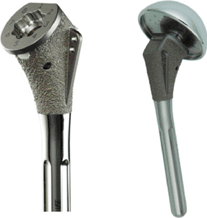 Imagen: El sistema modular de reemplazo de hombro Turon (Foto cortesía de DJO Global).